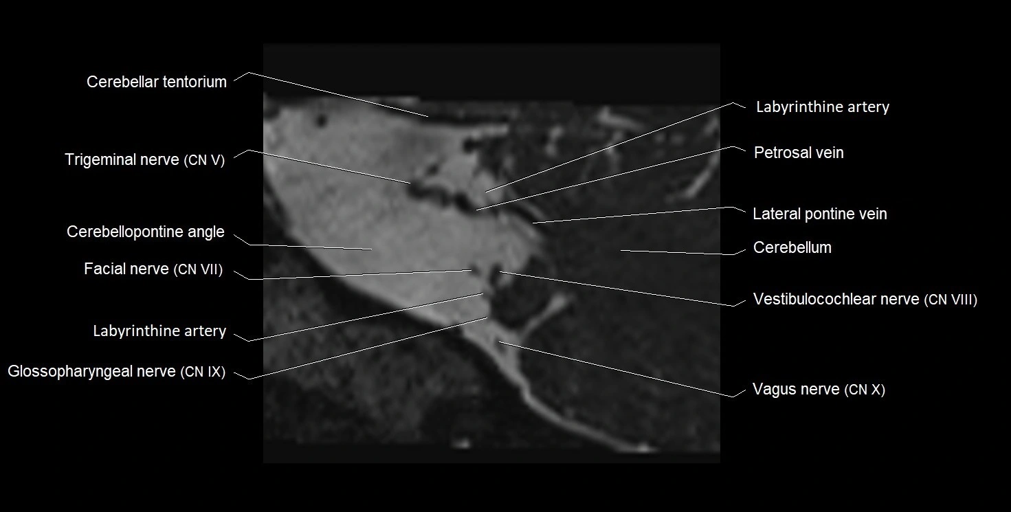 Internal auditory meatus (IAM) 3T sagittal cross sectional anatomy image 39.webp
